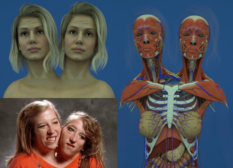 A Bond Beyond Biology: The Inspiring Life of Conjoined Twins Living in Harmony